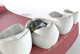 Fillings