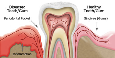 Gum Disease Treatment